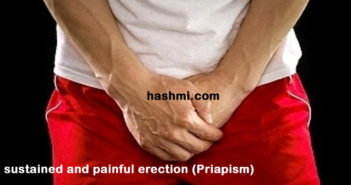 A sustained and painful erection (Priapism)